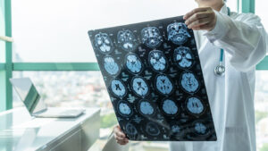 How Concussion Injuries Occur